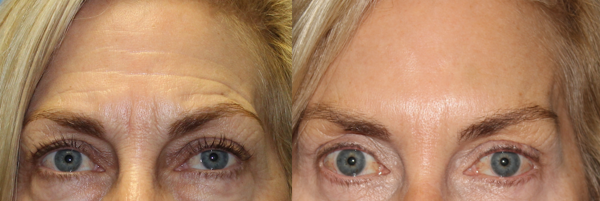 Botox before and after photo by Dr. Charles Anthony in Tampa FL