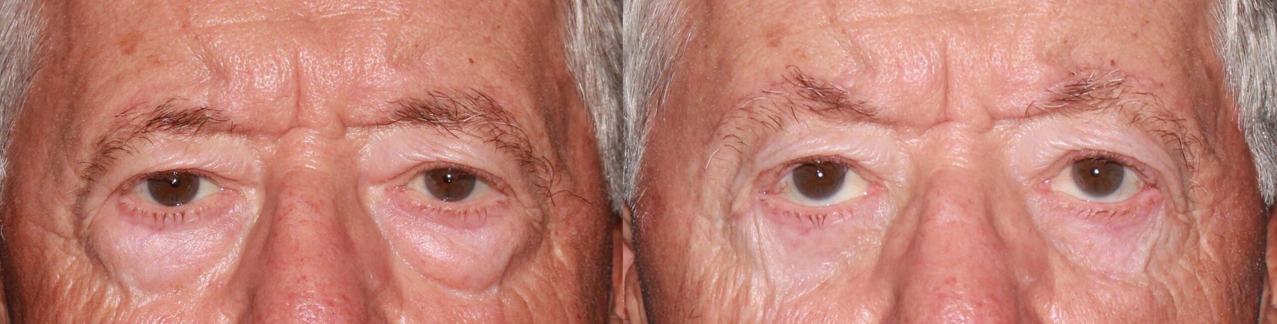 Brow Lift before and after photo by Dr. Charles Anthony in Tampa, FL