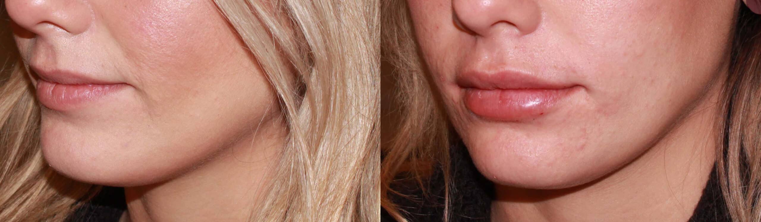Lip Lift before and after photo by Dr. Charles Anthony in Tampa, FL