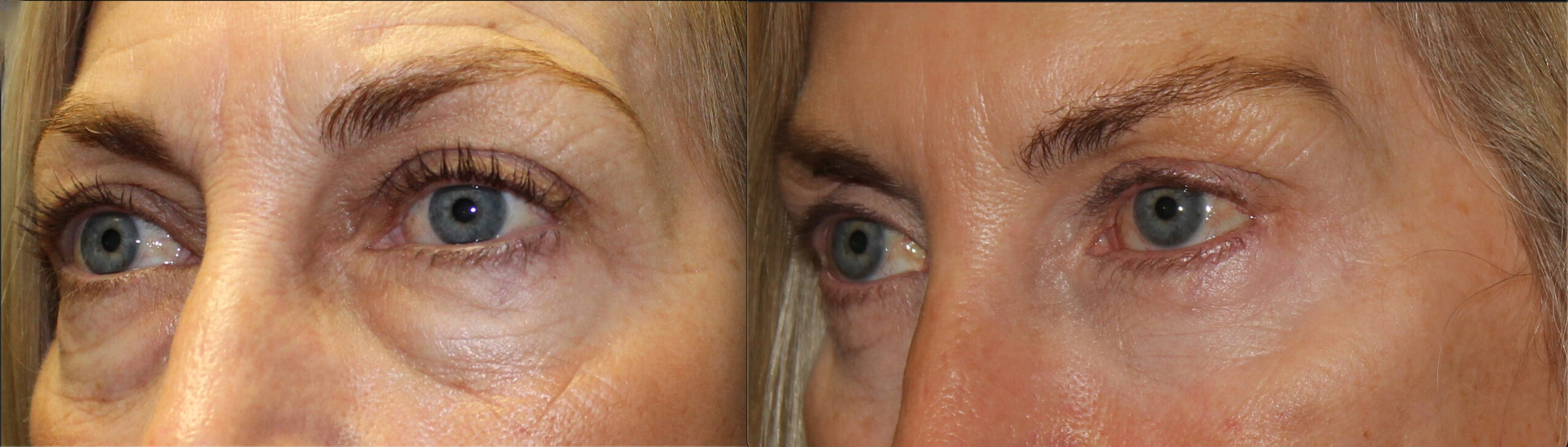 Lower Blepharoplasty before and after photo by Dr. Charles Anthony in Tampa, FL