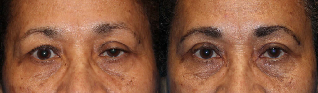 Upper Lid Ptosis Repair before and after photo by Dr. Charles Anthony in Tampa, FL