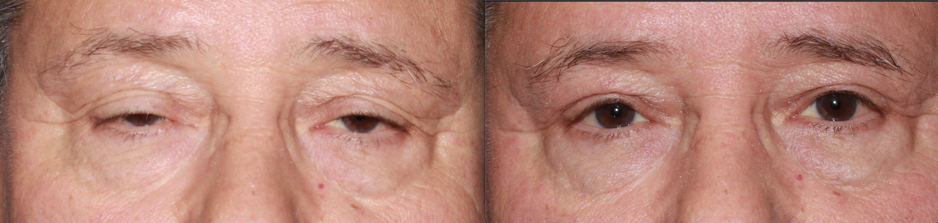 Upper Lid Ptosis Repair before and after photo by Dr. Charles Anthony in Tampa, FL