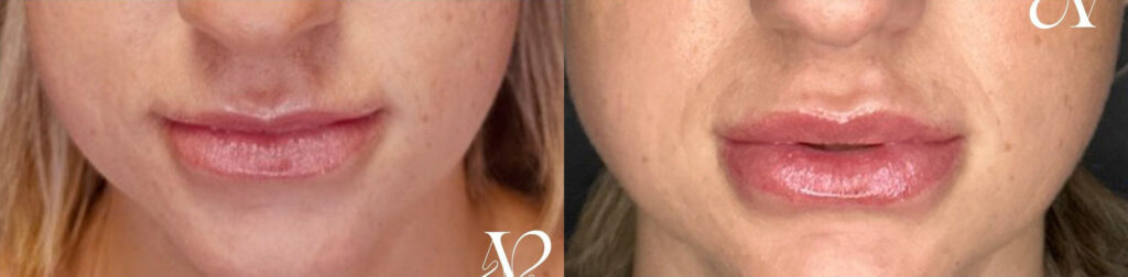 Lip Lift Before and After Photo by Dr. Charles Anthony in Tampa, FL