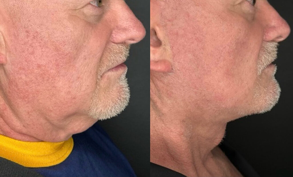 Facelift Before and After Photo by Dr. Charles Anthony in Tampa, FL