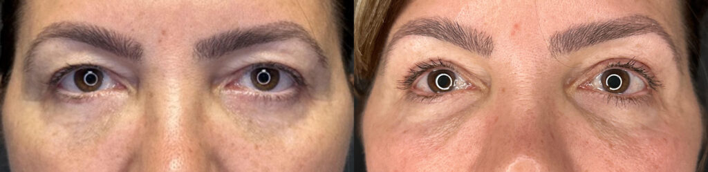 Upper Blepharoplasty Before and After Photo by Dr. Charles Anthony in Tampa, FL