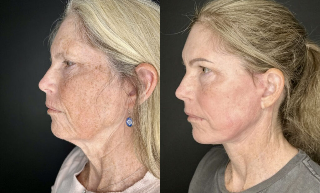 Facelift Before and After Photo by Dr. Charles Anthony in St. Petersburg, FL