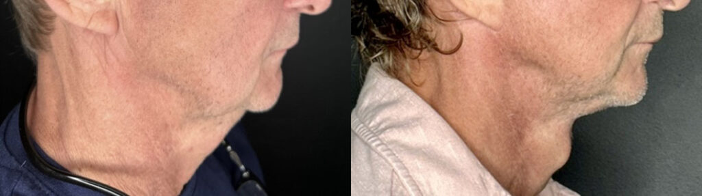 Facelift Before and After Photo by Dr. Charles Anthony in St. Petersburg, FL